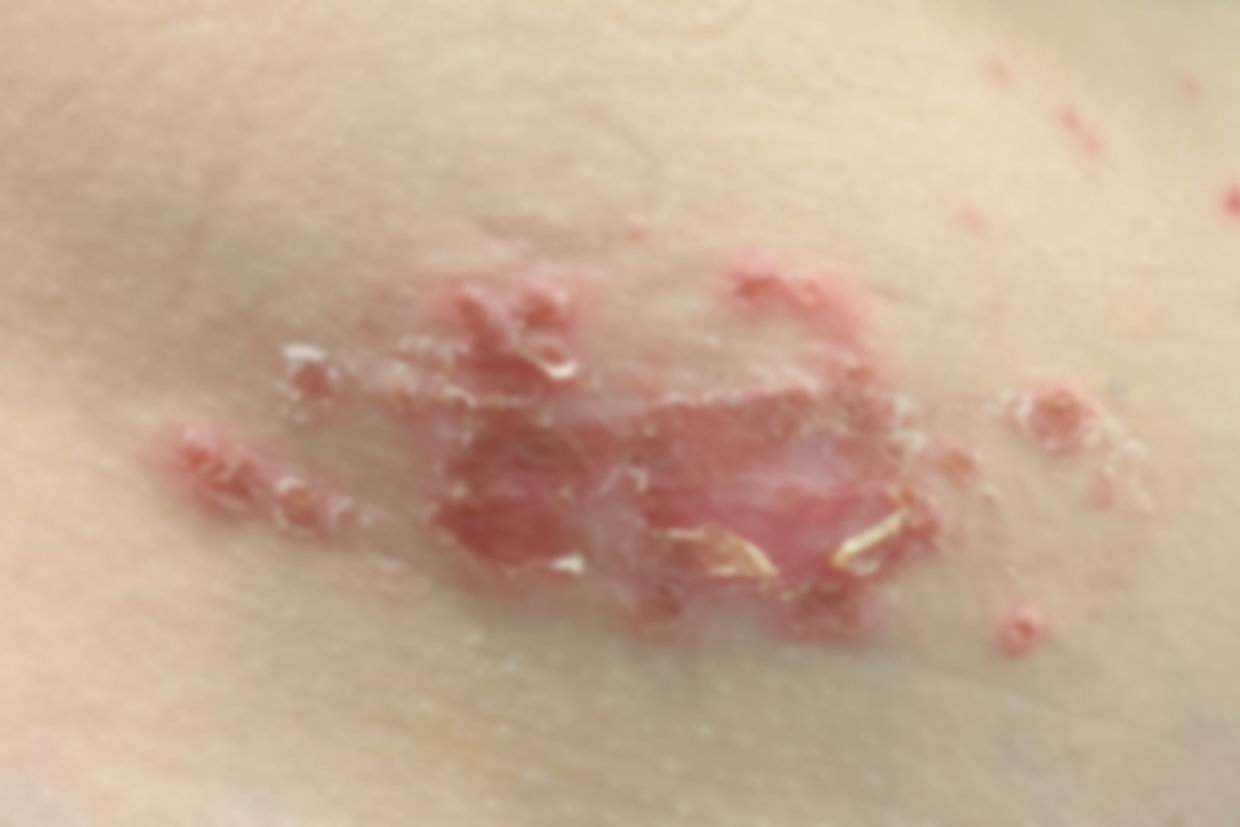 L’impetigine è un'infezione superficiale della pelle